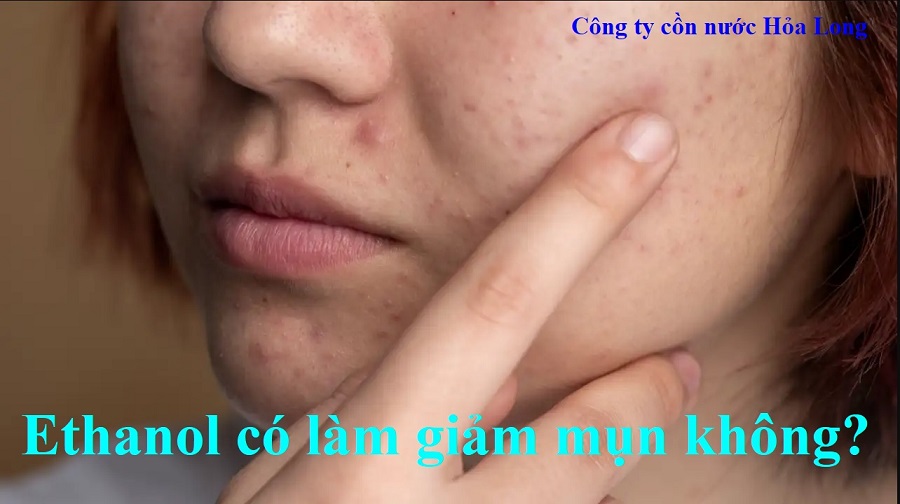 Ethanol có làm giảm mụn không? | Công ty Cồn nước Hỏa Long Alcohol